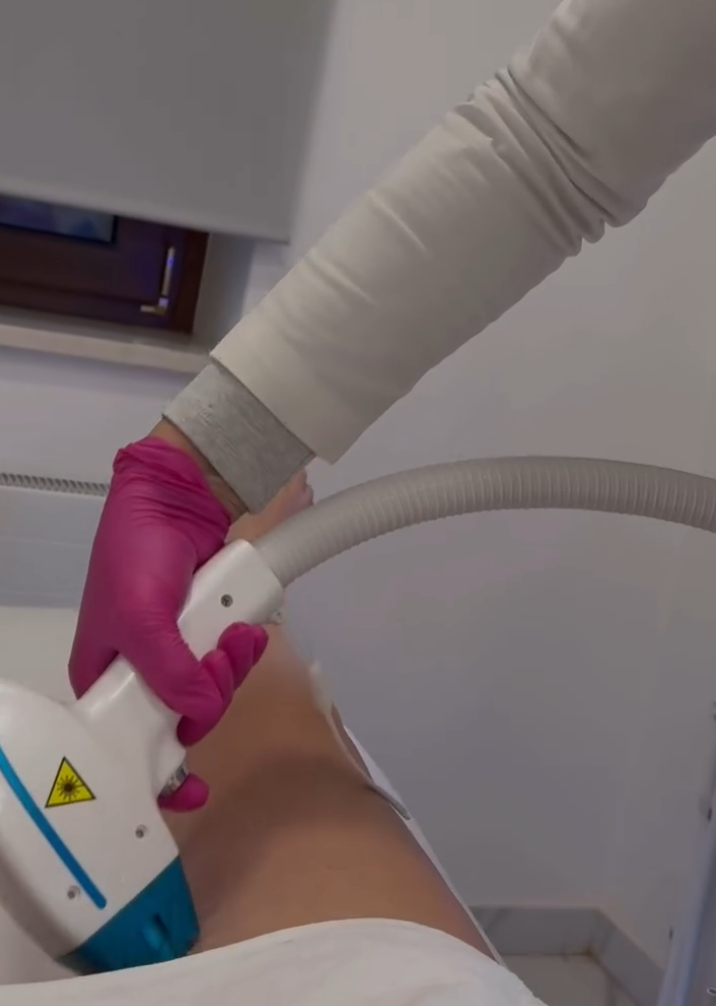 Alma Soprano laser za uklanjanje dlačica